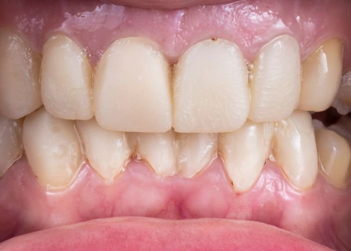 dientes antes despues (1)