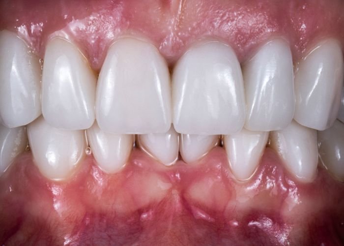 dientes antes despues
